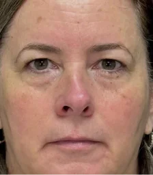 Real patient results in San Diego, CA Tiffany Pham MD Before and After