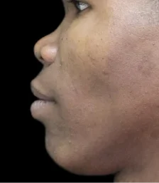 Real patient results in San Diego, CA Tiffany Pham MD Before and After