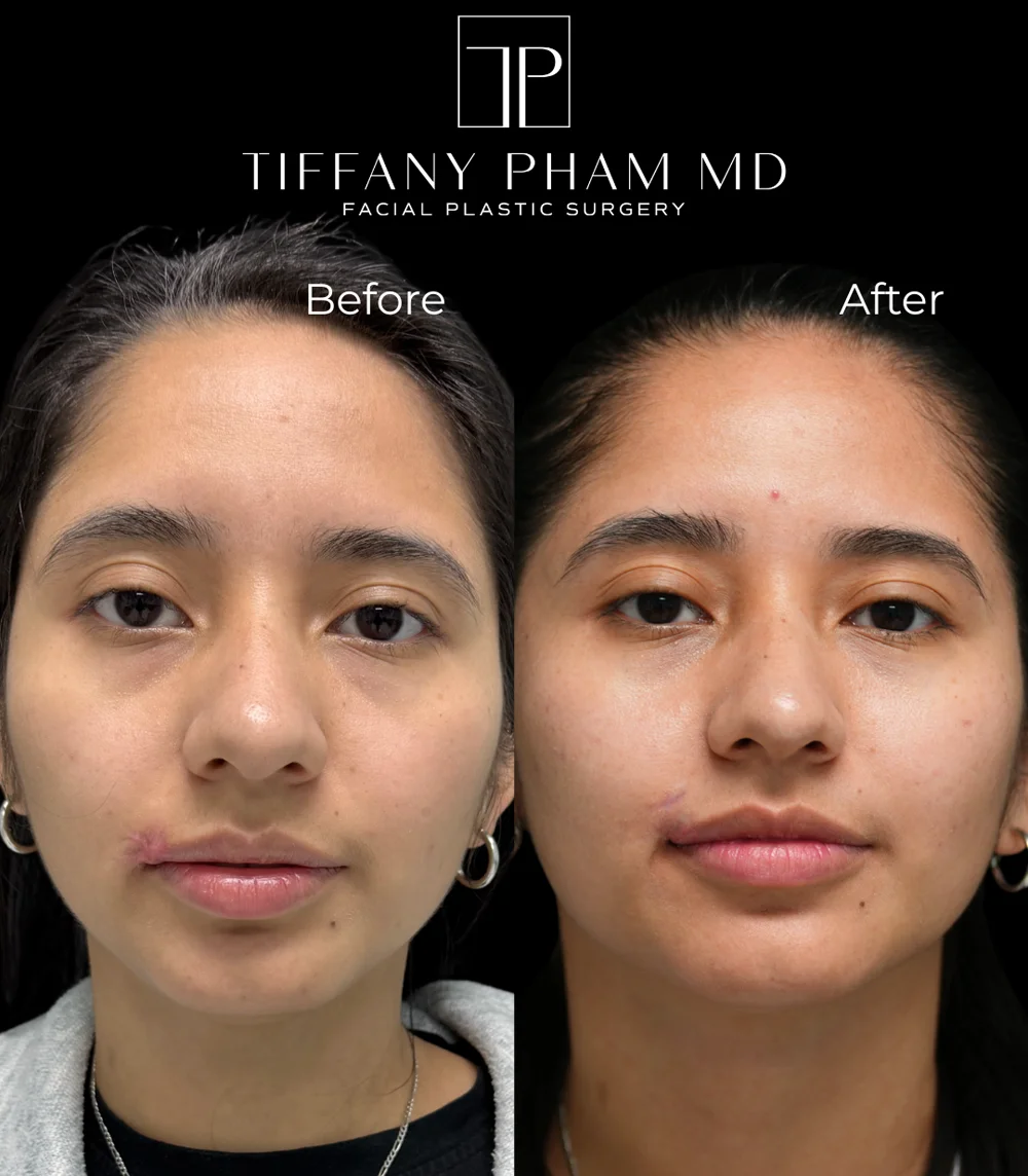 Real patient results in San Diego, CA Tiffany Pham MD Before and After