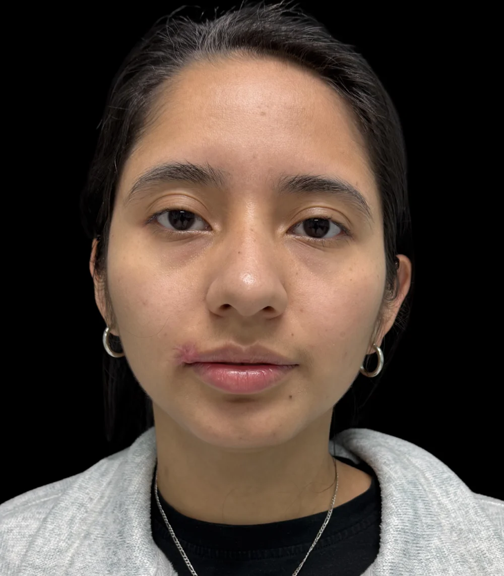 Real patient results in San Diego, CA Tiffany Pham MD Before and After