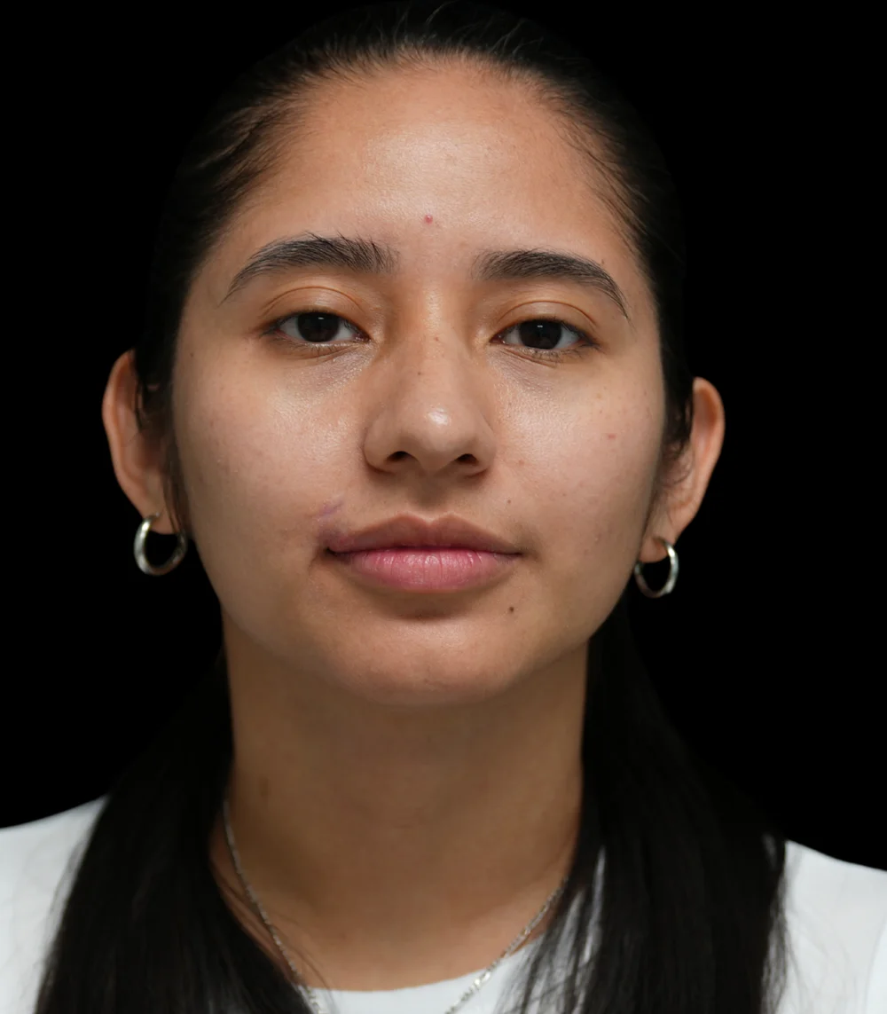 Real patient results in San Diego, CA Tiffany Pham MD Before and After