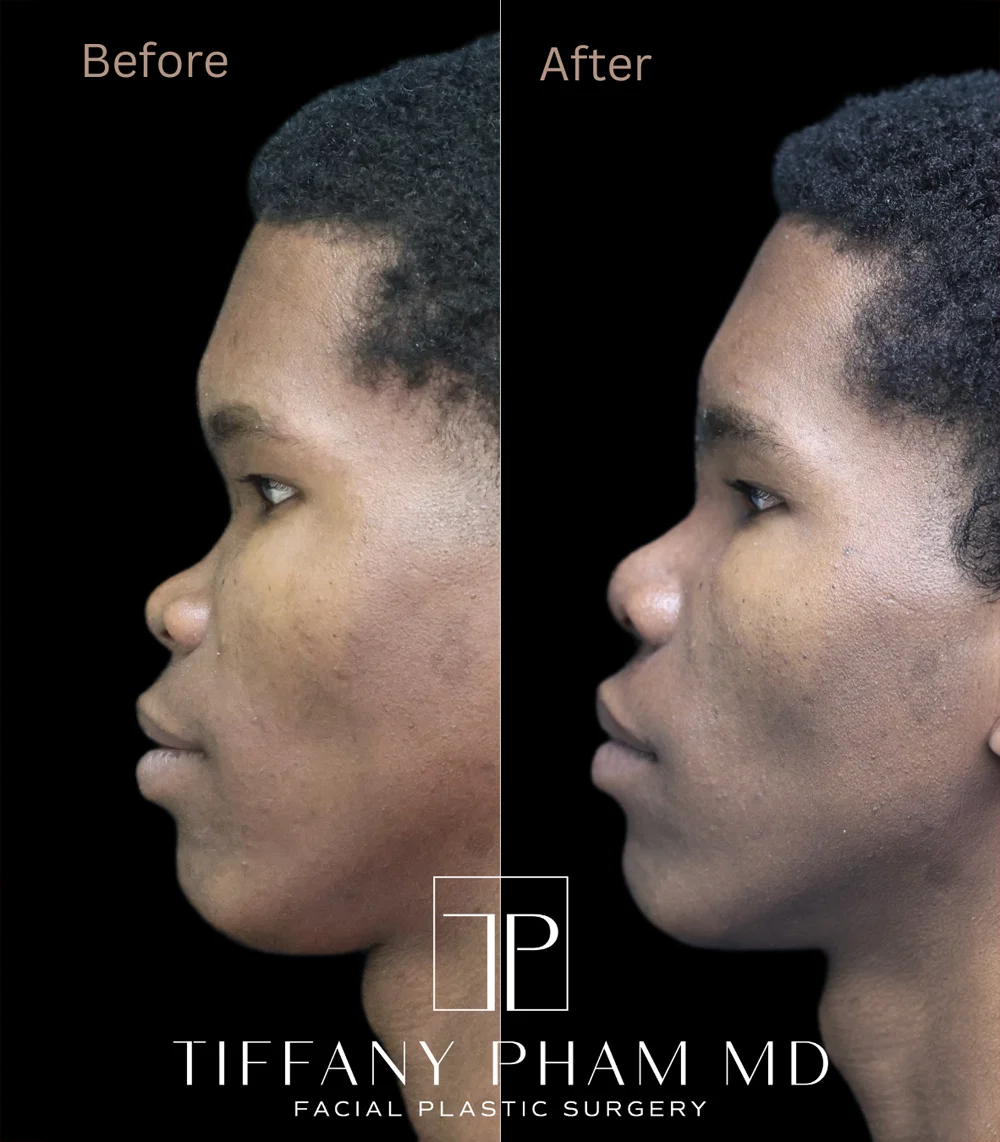 Real patient results in San Diego, CA Tiffany Pham MD Before and After