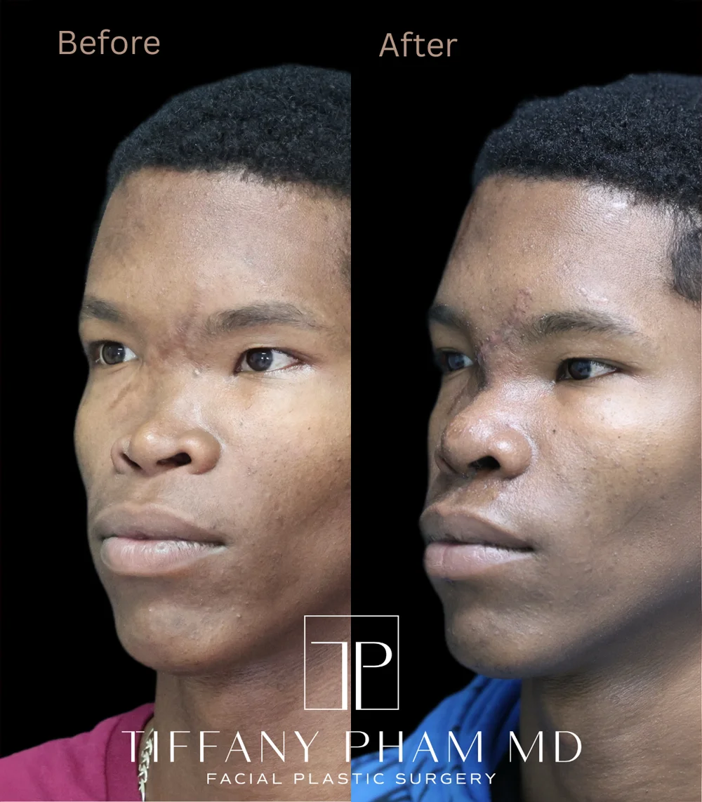 Real patient results in San Diego, CA Tiffany Pham MD Before and After