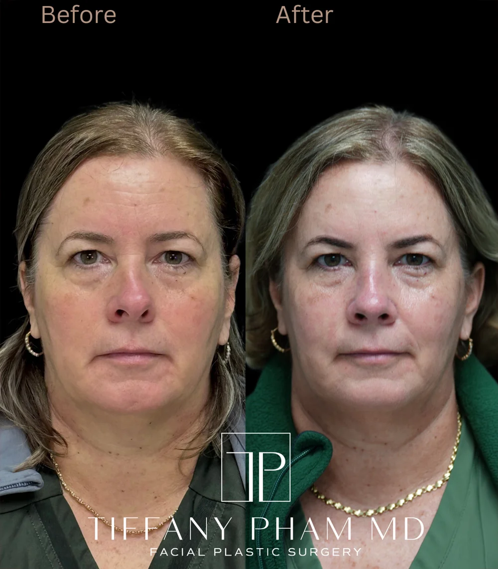 Real patient results in San Diego, CA Tiffany Pham MD Before and After