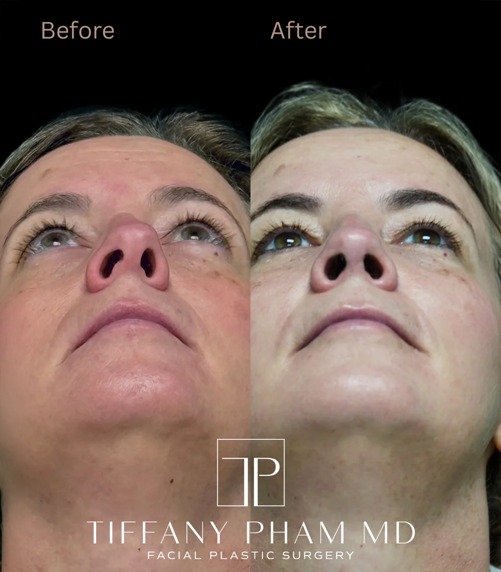 Real patient results in San Diego, CA Tiffany Pham MD Before and After