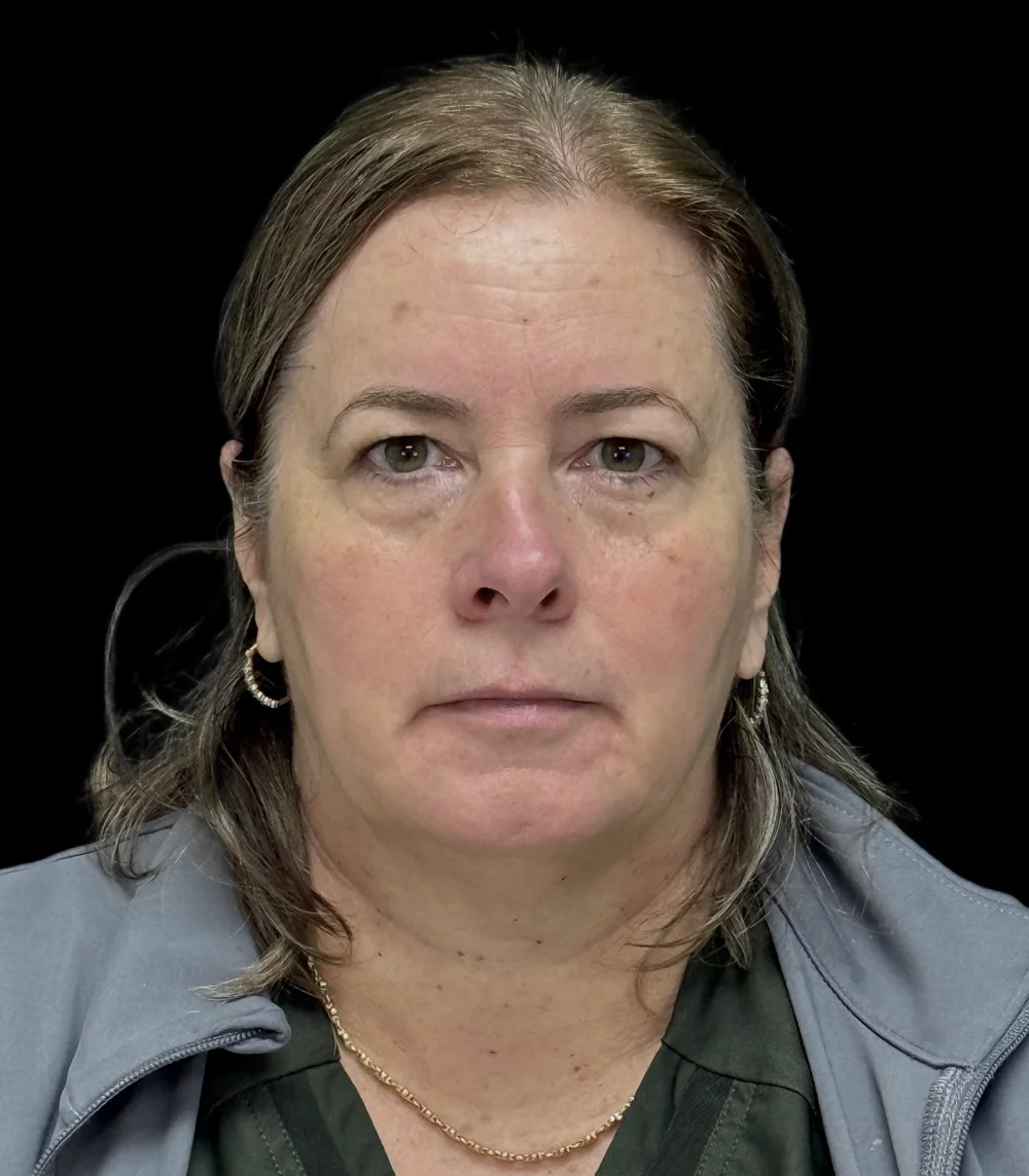 Real patient results in San Diego, CA Tiffany Pham MD Before and After