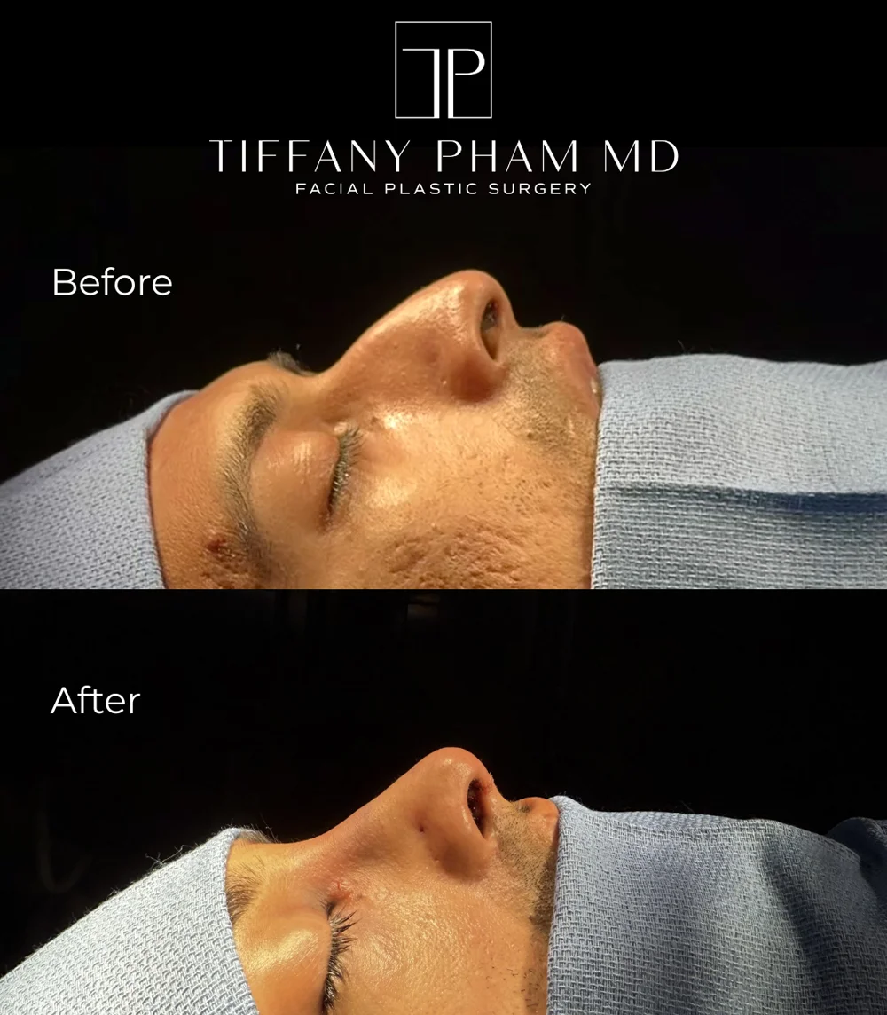Real patient results in San Diego, CA Tiffany Pham MD Before and After