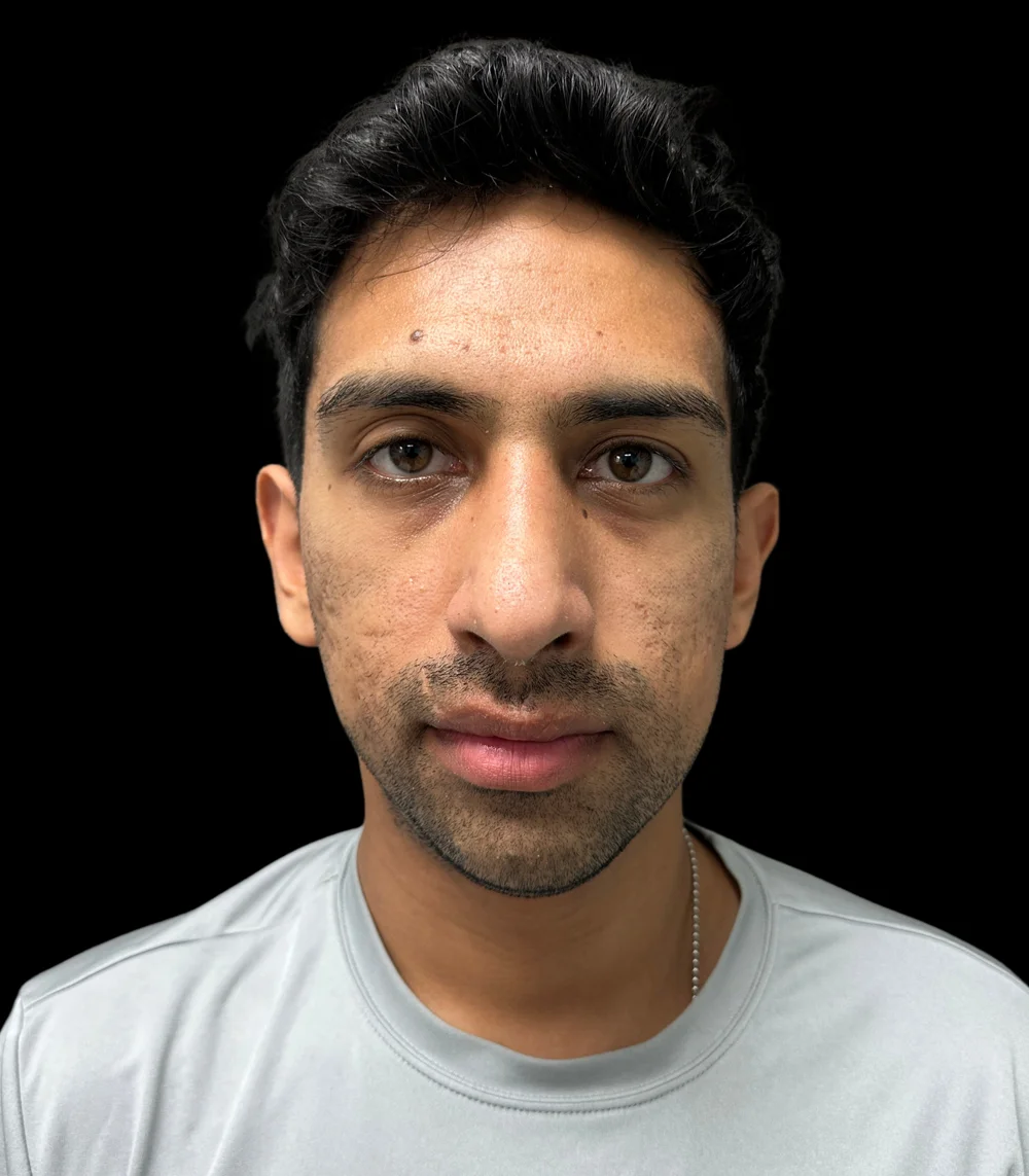 Real patient results in San Diego, CA Tiffany Pham MD Before and After