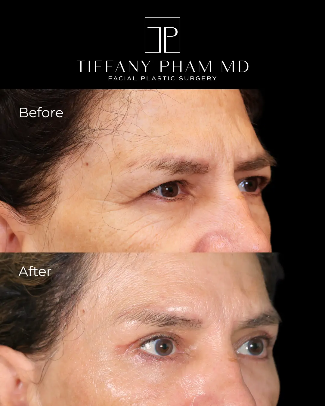 brow3