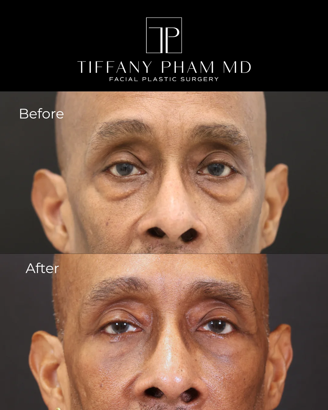 lower blepharoplasty fat transfer