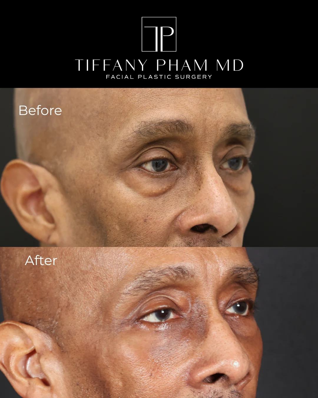 lower blepharoplasty fat transfer