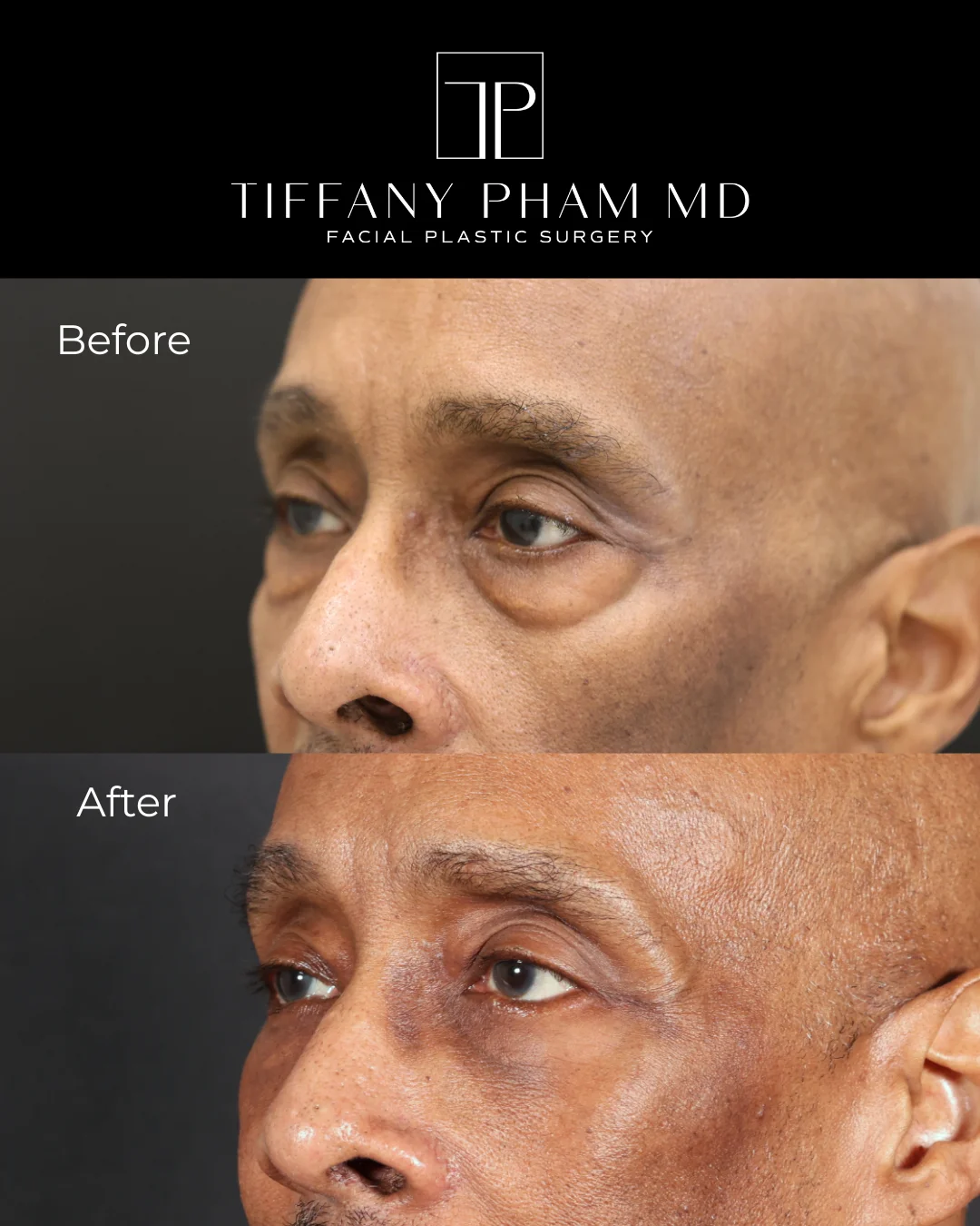 lower blepharoplasty fat transfer